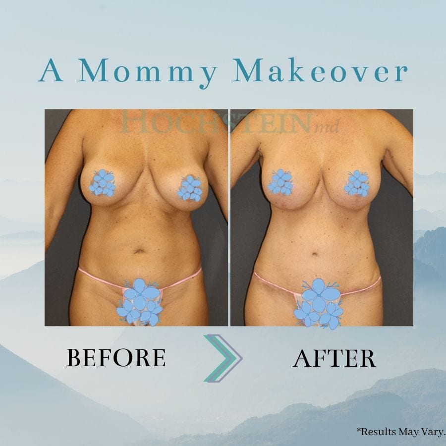 Before and after image showing the results of a Mommy Makeover performed in Miami.