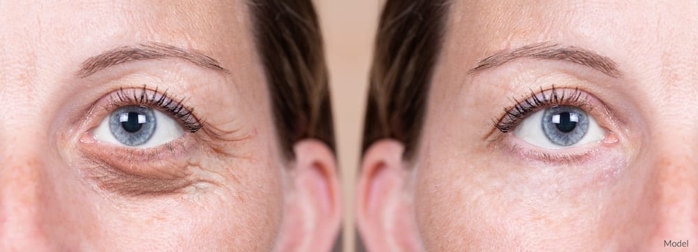 before and after of an eyelid surgery procedure