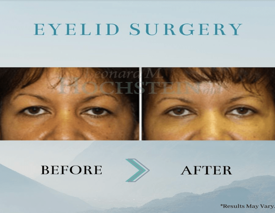 Before and after image showing the results of a eyelid surgery performed in Miami by Dr. Hochstein.