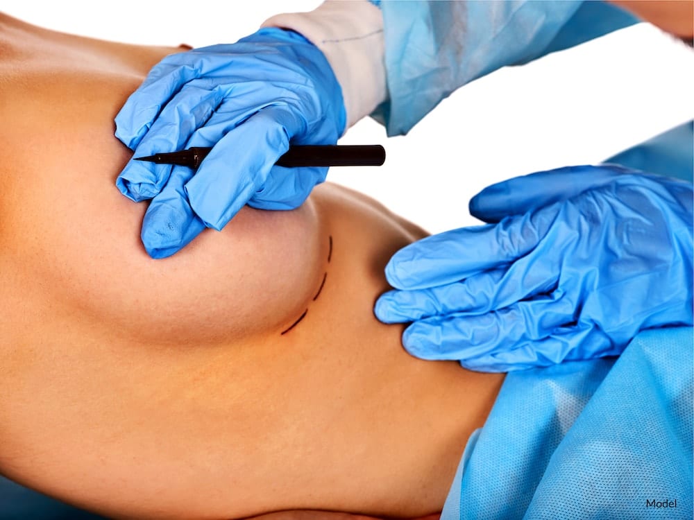 Woman with surgical lines drawn beneath breast to prepare for breast revision.