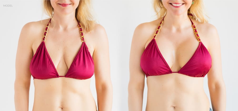 Side-by-side image of a woman with or without breast enhancement 