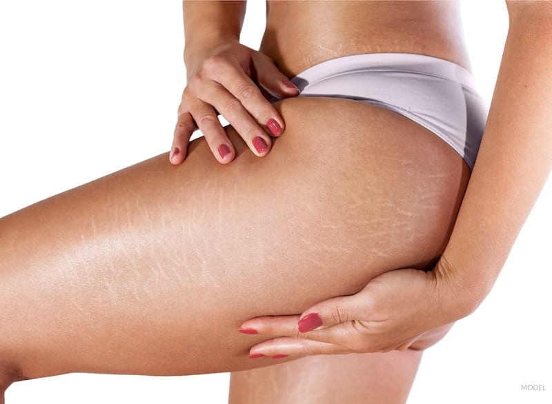 Woman's hands around her stretch marks on her thigh.