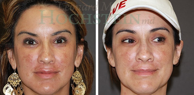 Halo Laser Patient Before and After