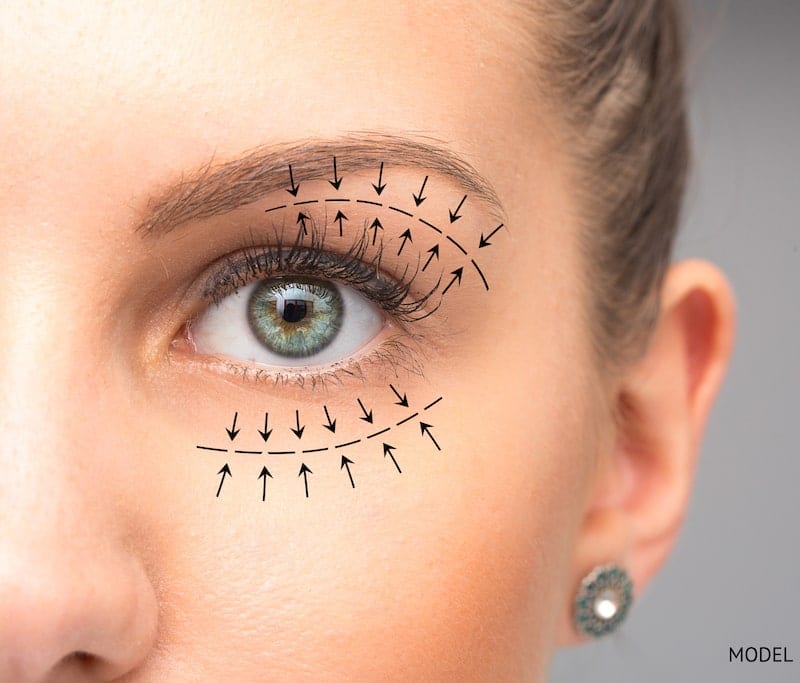 Close-up image of a woman's eye with surgical arrows showing eyelid rejuvenation concept.