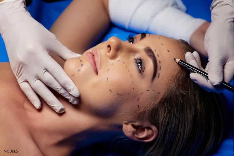 Woman preparing for a facial surgery with surgical lines drawn on face.