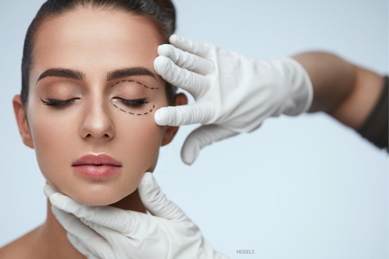 Surgeon's hands examining a woman's eyelid with surgical lines drawn on upper and lower eyelids.