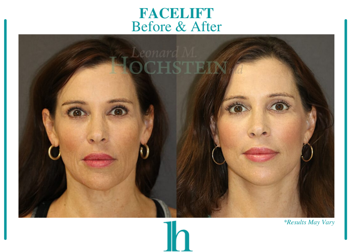Before and after image showing the results of a facelift performed in Miami, FL.