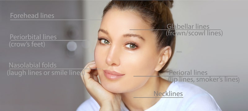 Woman's face labeled with common types of facial wrinkles/