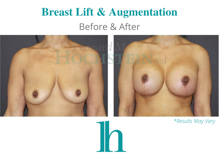 Before and after image showing the results of a breast lift and augmentation performed in Miami, FL.