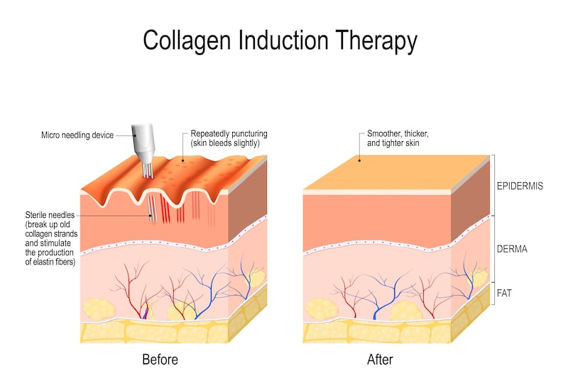 Illustration demonstrating what collagen induction therapy (microneedling) does to the skin layers.