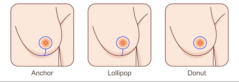 Illustration of different breast lift incision options: anchor, lollipop, donut.