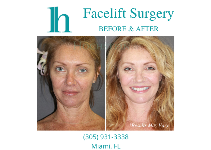 Before and after image showing the results of a facelift performed in Miami, FL.