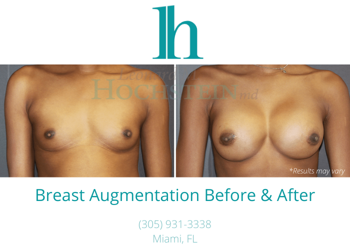  Before and after image showing the results of a breast augmentation performed in Miami, FL.