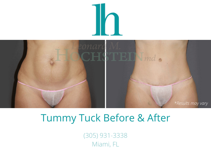 Before and after image showing the results of a tummy tuck performed in Miami, FL.