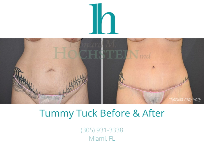 Before and after image showing the results of a tummy tuck performed in Miami.