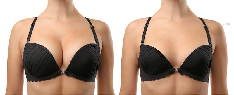 Before and after breast reduction. Model in black bra.