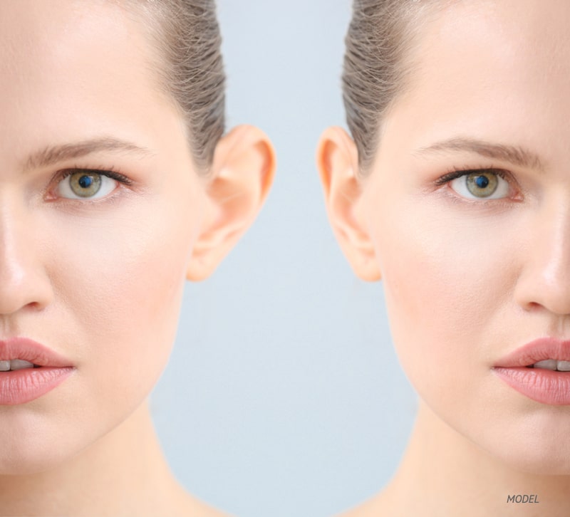 Before and after photo of a woman with large protruding ears after otoplasty.