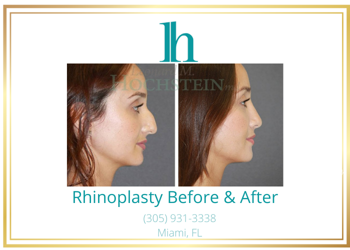 Before and after image showing the results of a rhinoplasty performed in Miami, FL.