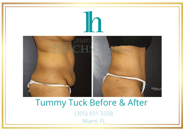 Before and after image showing the results of a tummy tuck performed in Miami, FL.