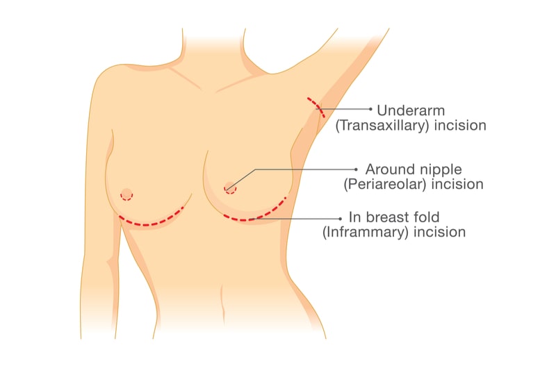 Diagram of breast augmentation incision options.