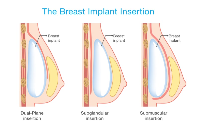 Illustrated diagram of breast implant placement options.