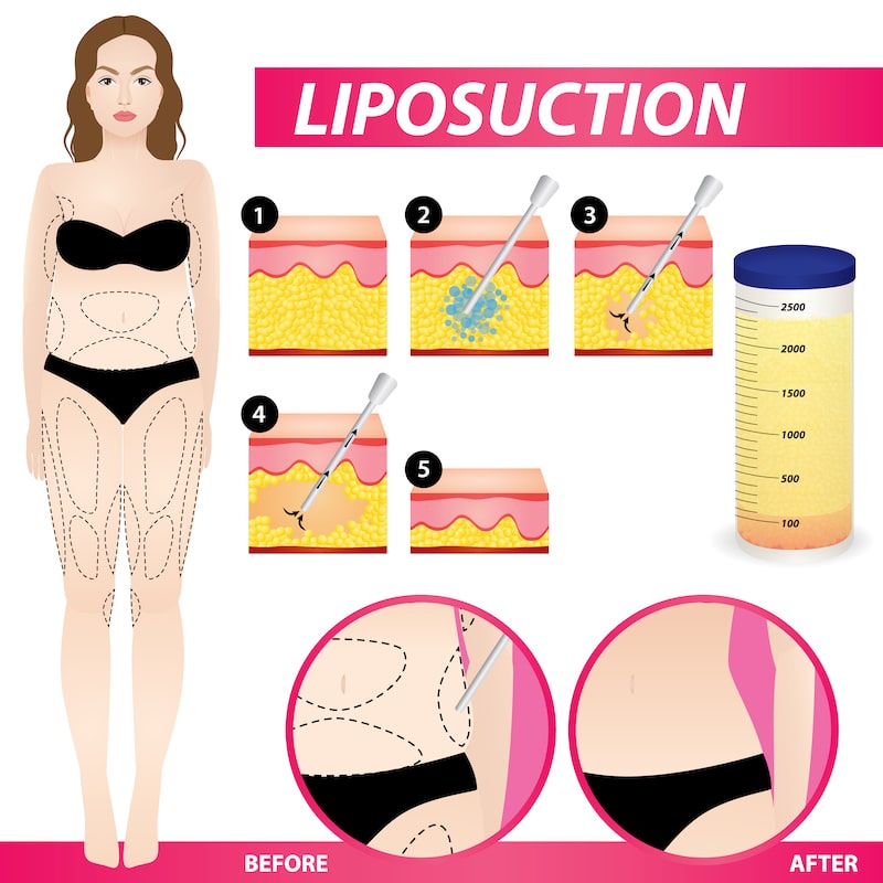 Illustrated demonstration of what is accomplished with liposuction