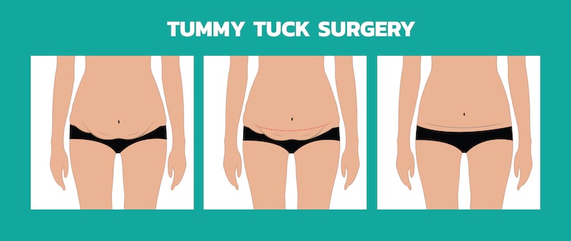 Illustrated demonstration of what is accomplished with a tummy tuck