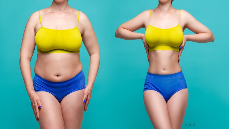  before and after photo of tummy tuck and plastic surgery recontouring.