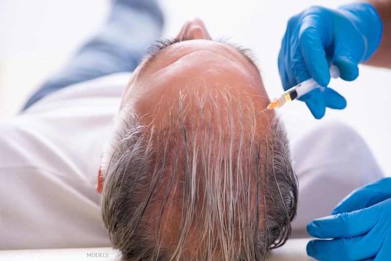 PRP being injected into man's balding scalp.