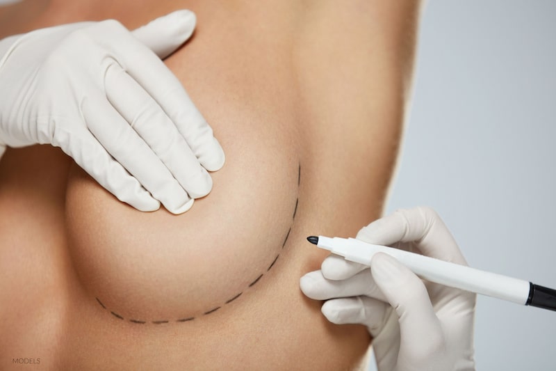 Woman having her breast marked for implant surgery.