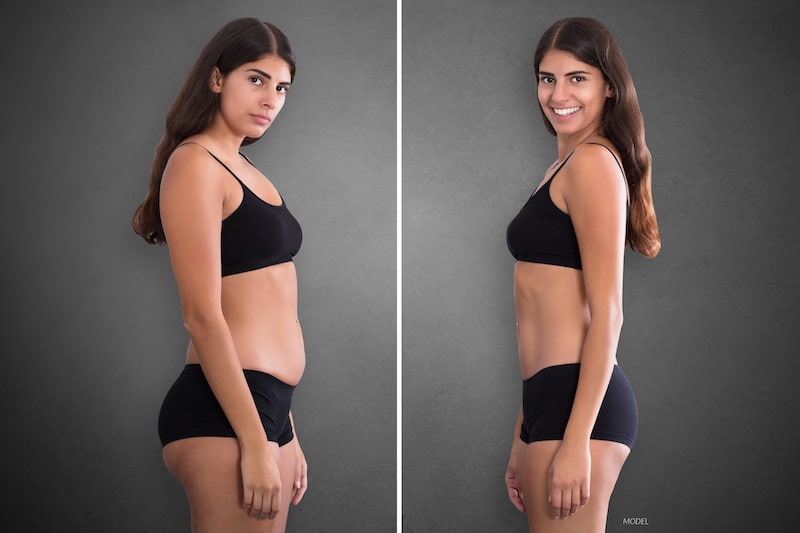 Profile images of attractive woman before and after body contouring fat loss