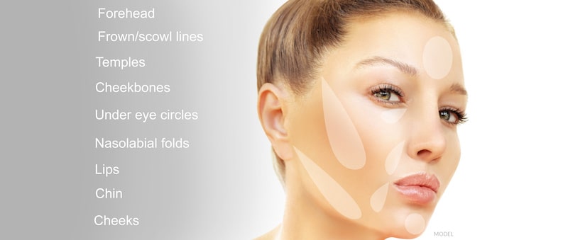 Image of a face showing all the treatment areas that can be helped with dermal fillers.