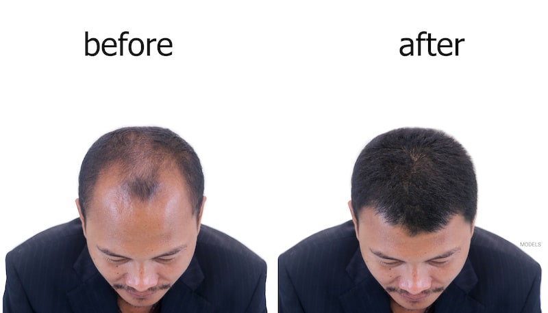 Before and after hair loss treatment.