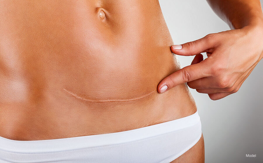 woman with toned stomach points to a surgical scar