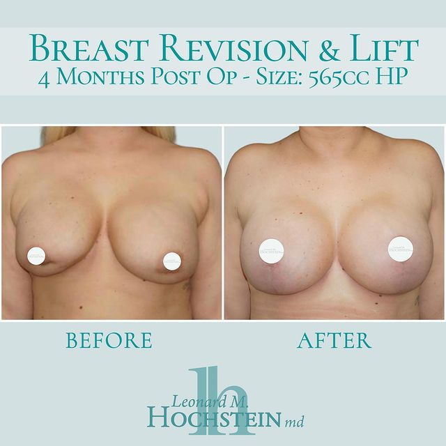 Before and after Breast Revision and lift. Surgery performed by Dr. Hochstein
