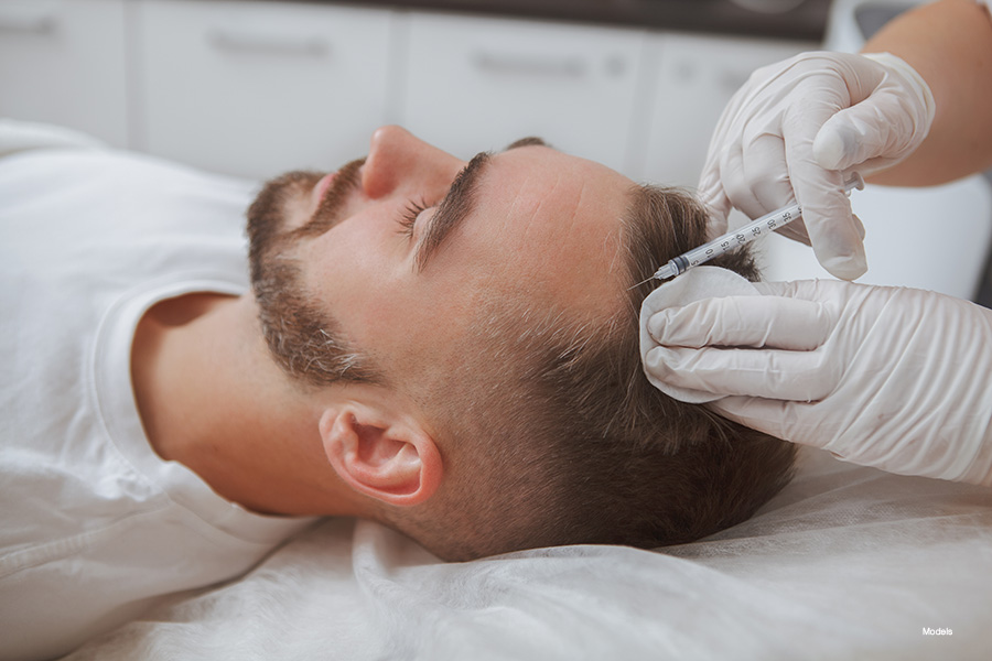 A man with a well-trimmed beard and mustache, wearing a white t-shirt, receives a PRP injection to treat his hair loss.