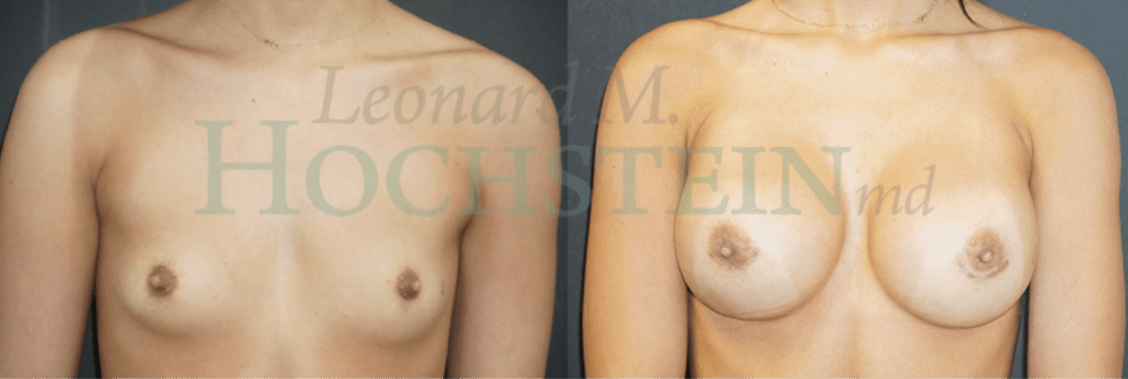 Before and after patient results