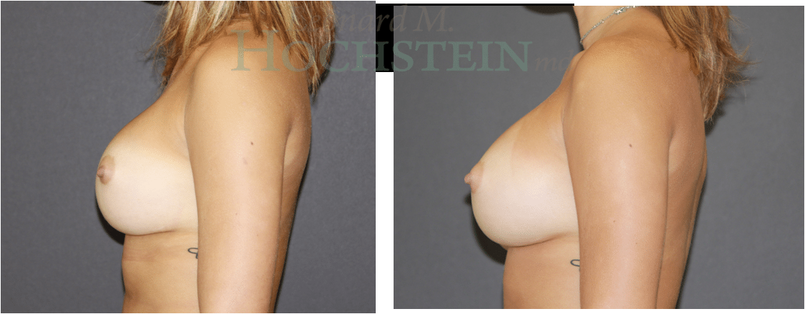 Breast Revision Patient