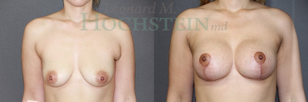 Breast Lift With Implants Patient