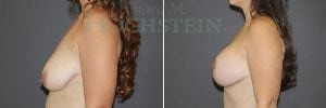 Breast Lift With Implants Patient