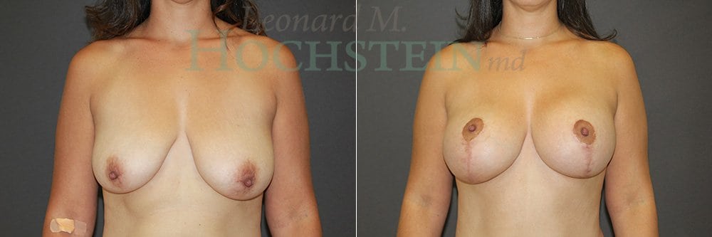 Breast Lift With Implants Patient