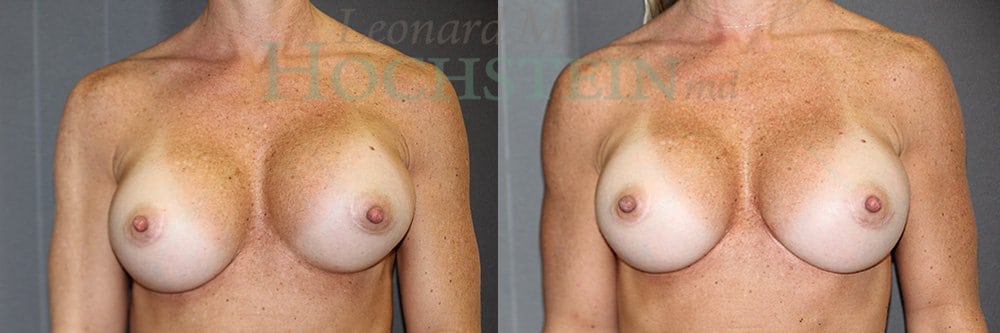 Breast Revision Patient