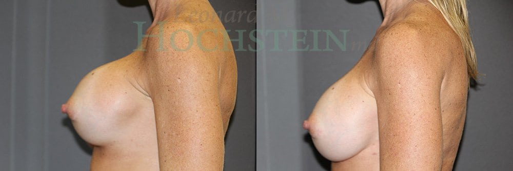 Breast Revision Patient