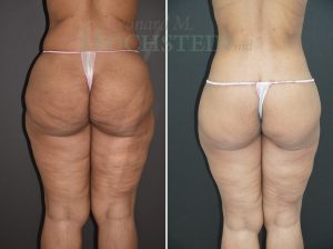 Buttock Lift Patient 01