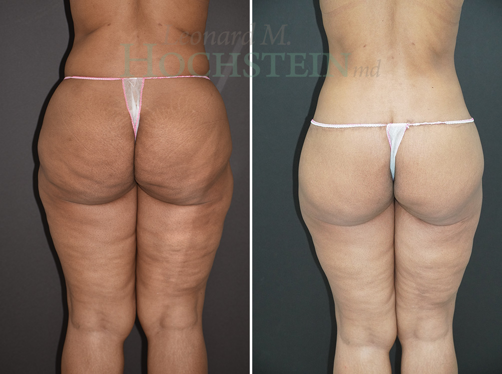 Buttock Lift Patient