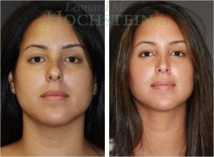 Rhinoplasty Patient