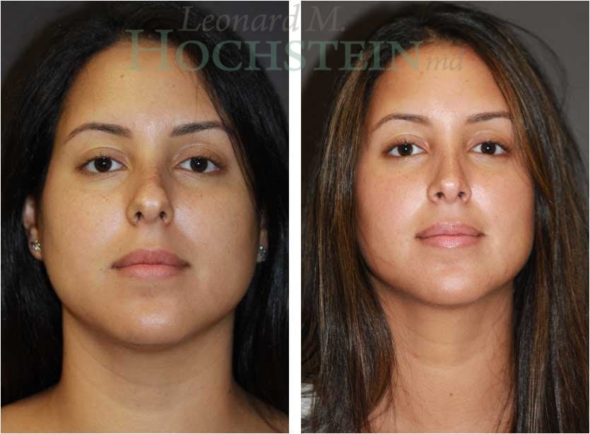 Rhinoplasty Patient