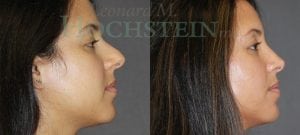 Rhinoplasty Patient
