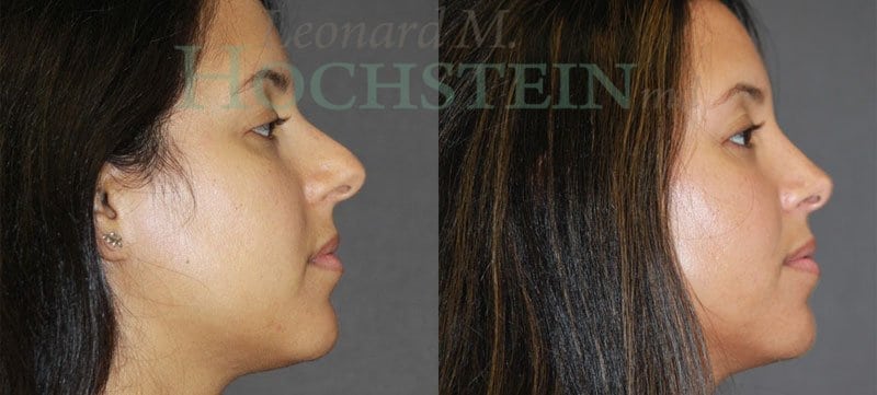 Rhinoplasty Patient
