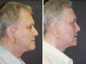 Facelift Patient